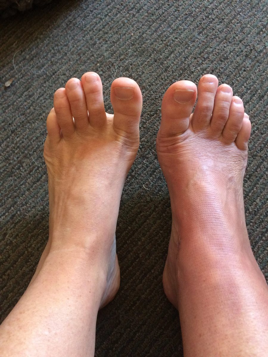 Lisa’s CRPS swelling comparison while using the Oska Wellness Device