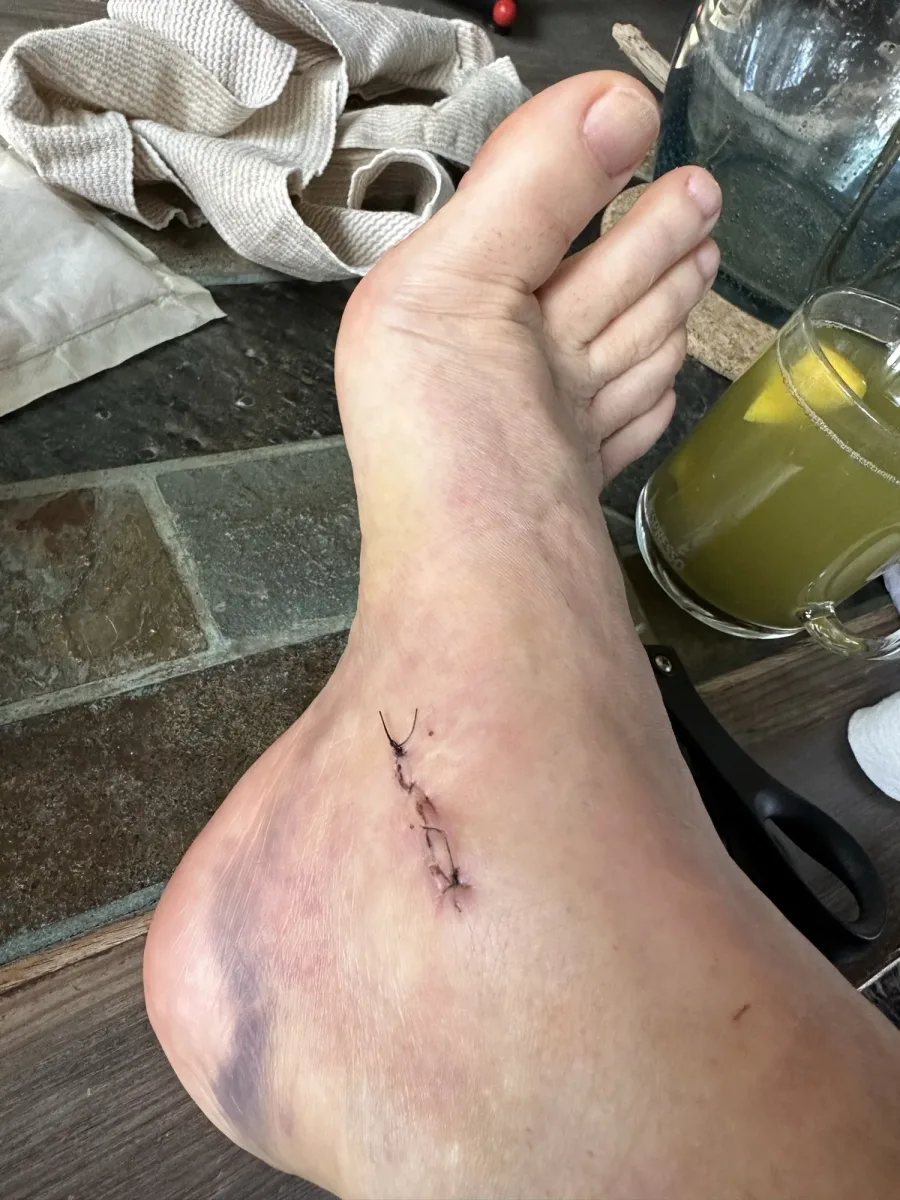Titanium screw removal and CRPS