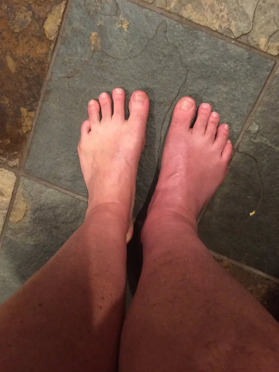 Complex Regional Pain Syndrome following a severe leg and ankle fracture